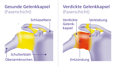 Frozen Shoulder: Ursachen, Symptome und Behandlung der Schultersteife (1)
