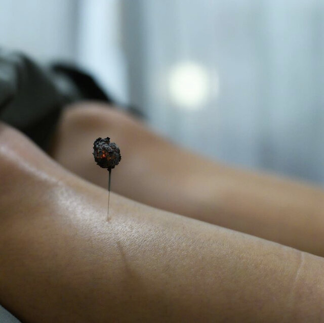 What Is Moxa, How Is It Used, And What Are The Benefits? — Wild Earth Acupuncture - Portland, Oregon (2)